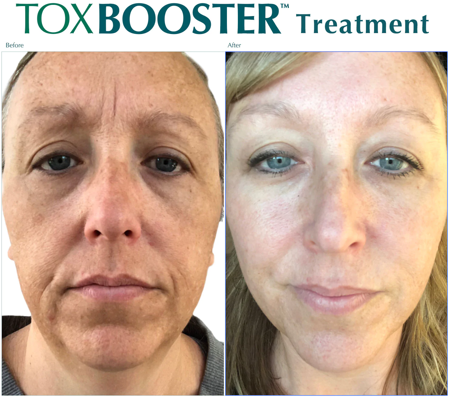 Before and After Toxbooster Treatment