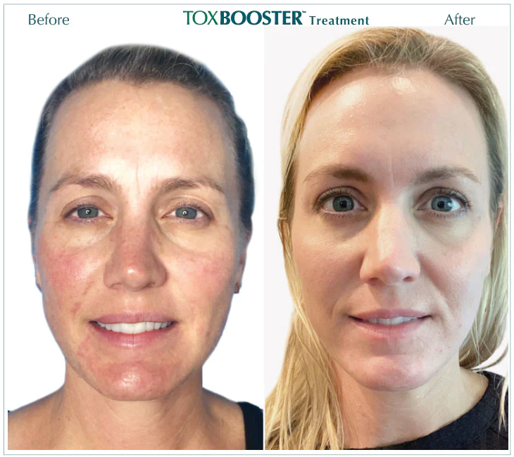 Before and After Glotox Treatment
